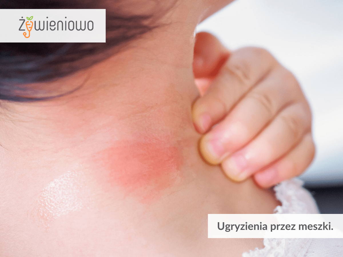 Ugryzienia przez&nbsp;meszki.