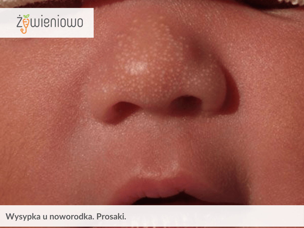 Wysypka u&nbsp;noworodka. Prosaki.