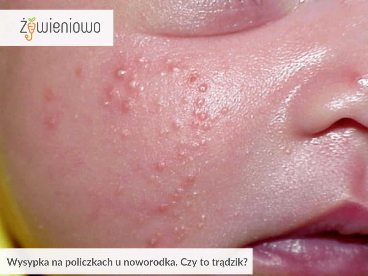 Wysypka na&nbsp;policzkach u&nbsp;noworodka. Czy&nbsp;to&nbsp;trądzik?